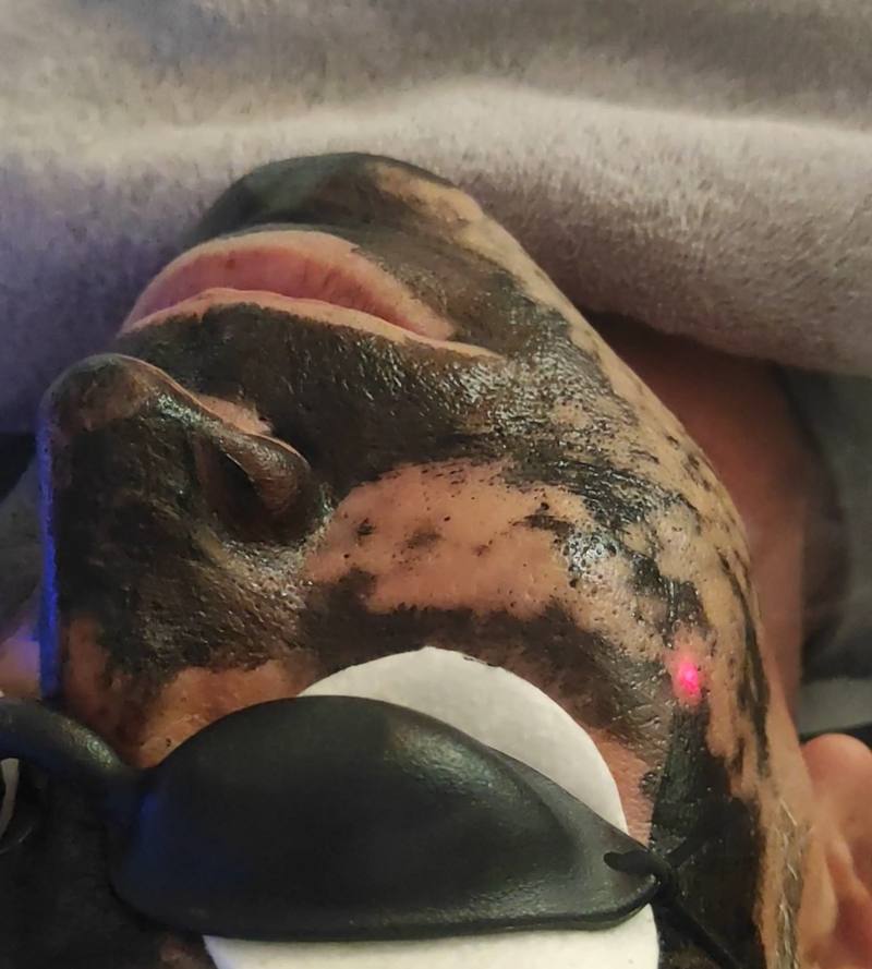 Tratamiento Carbon Peel